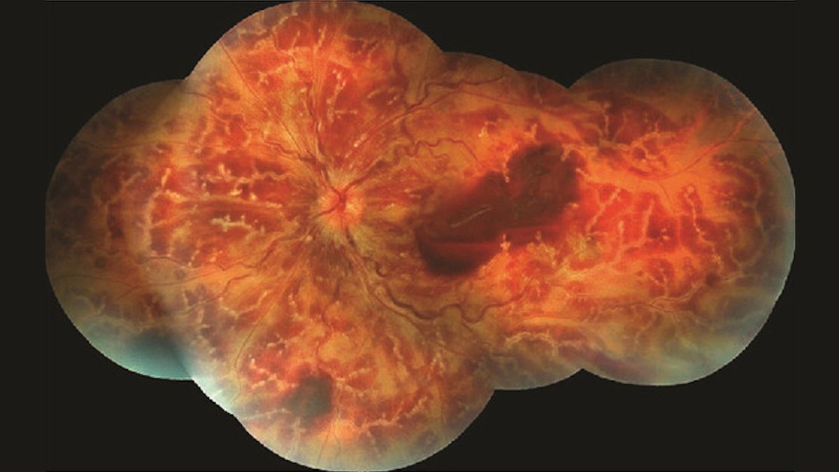 Angéite des branches givrées : une maladie oculaire rare qui fait ressembler la rétine à un arbre givré