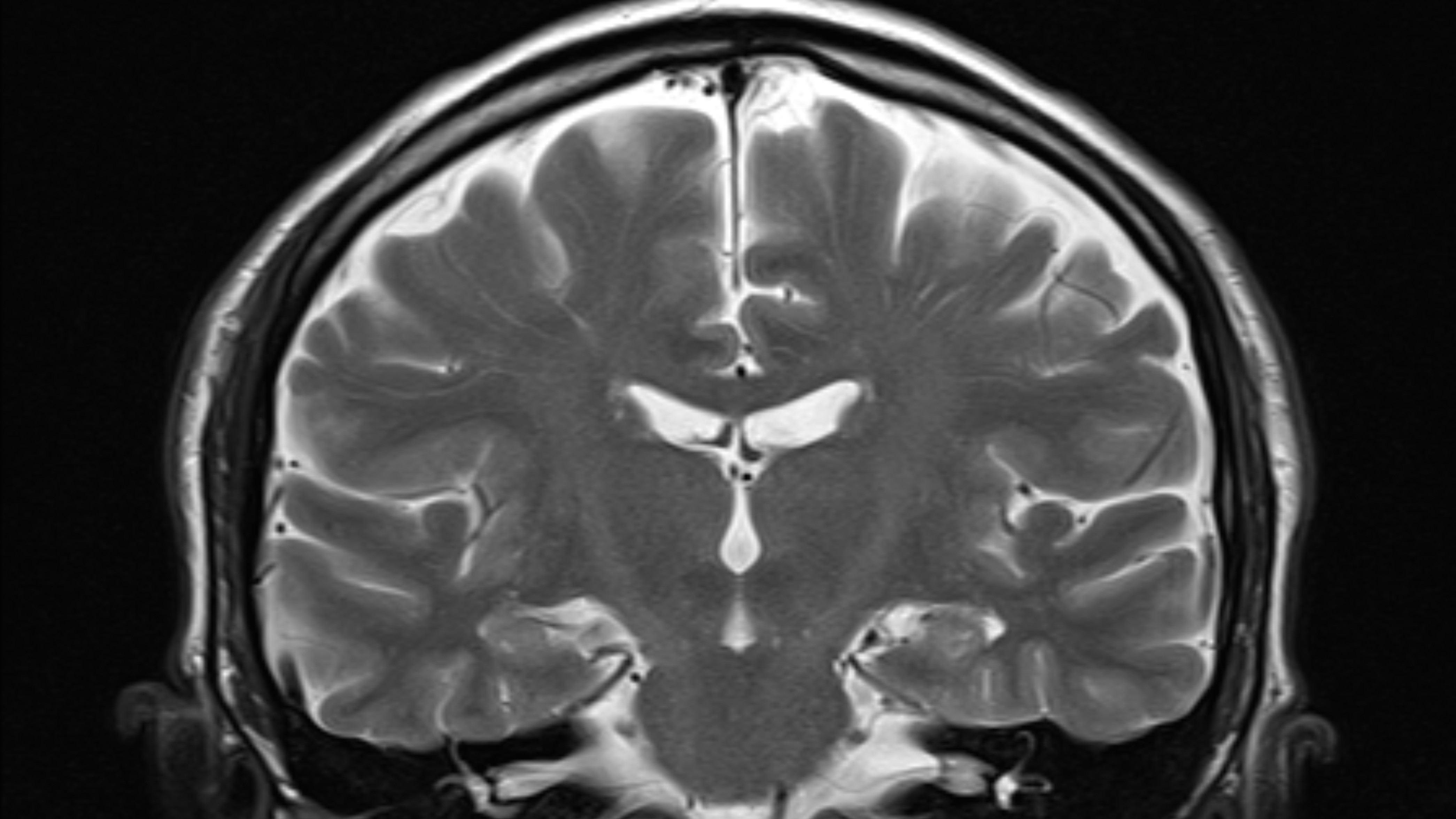 Une IRM d'un cerveau humain