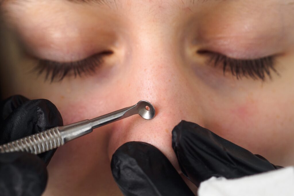 Outil d'extracteur de pores