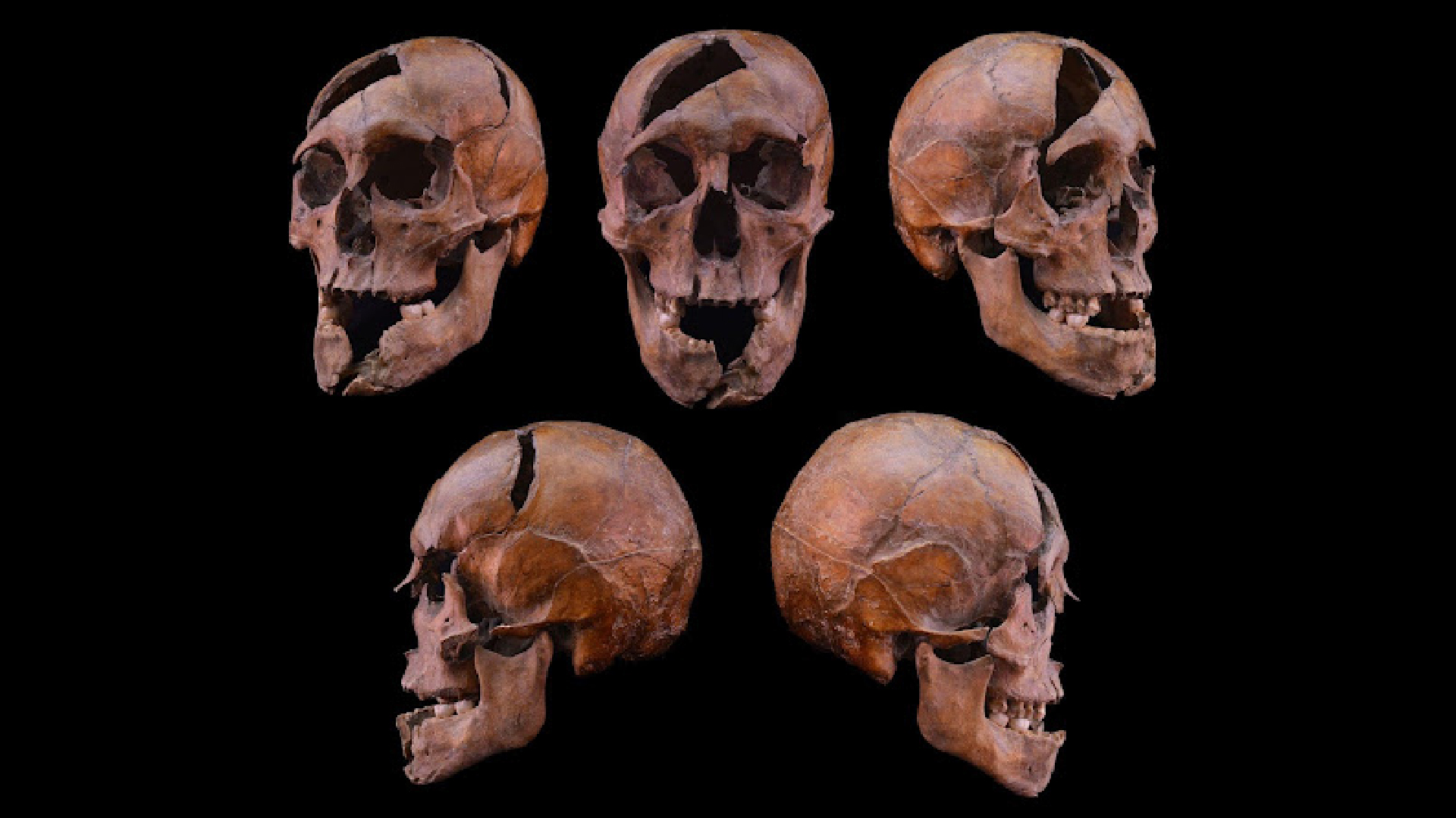 Plusieurs angles d'un crâne avec de grands trous et fissures