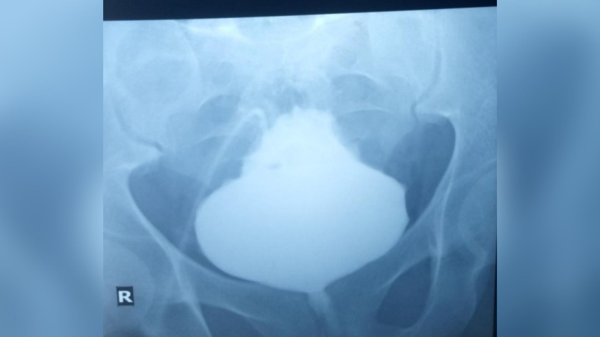 medical image of a man's pelvis with full bladder shown in the center
