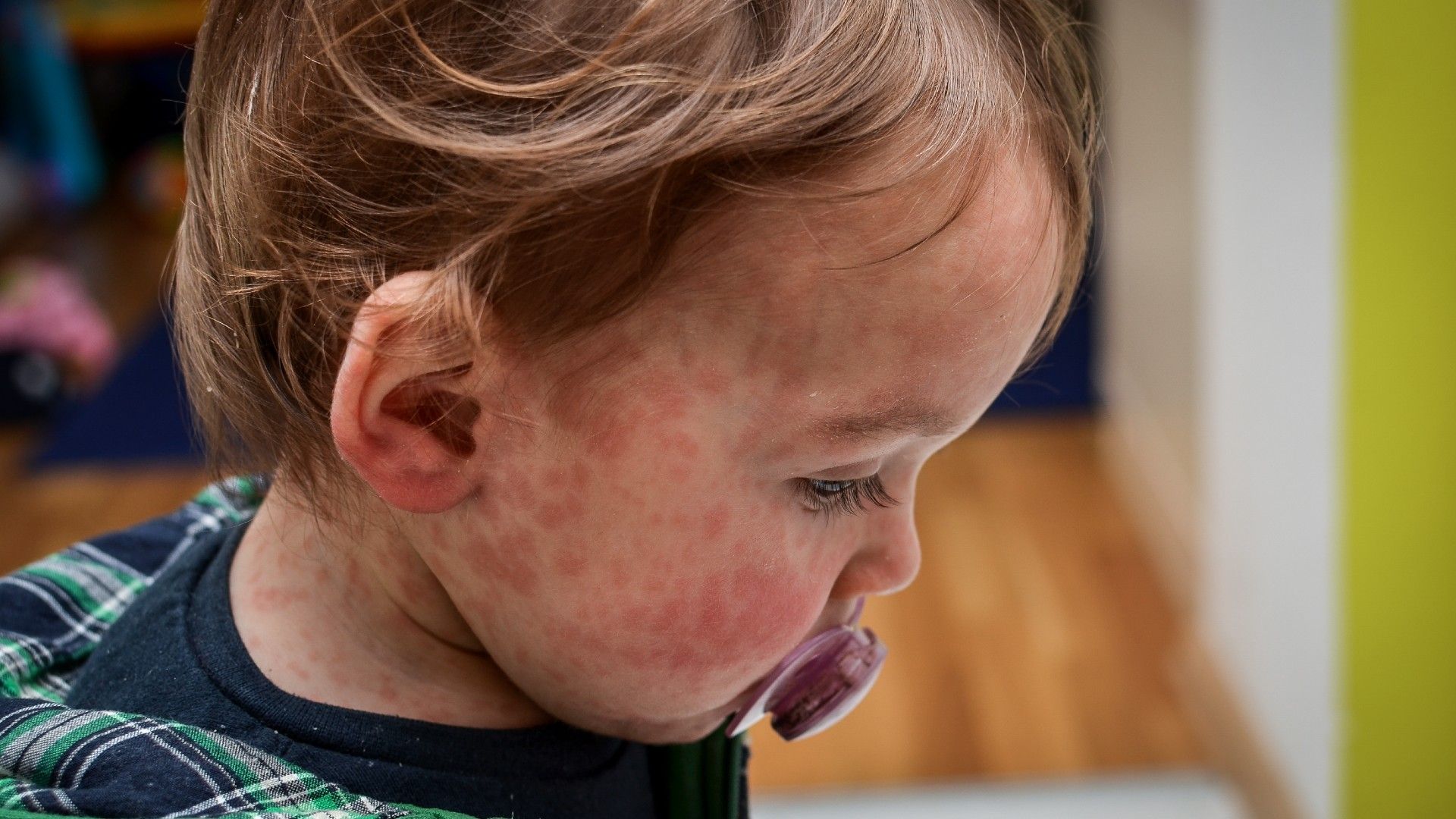 A close-up shot of the side profile of a child with a red rash on their face caused by measles. The child is wearing a dummy and looking down.