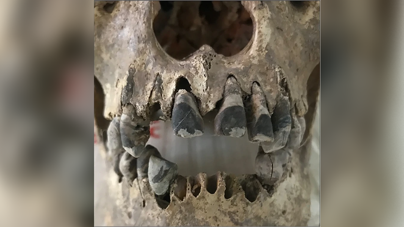 a human skull with blackened teeth