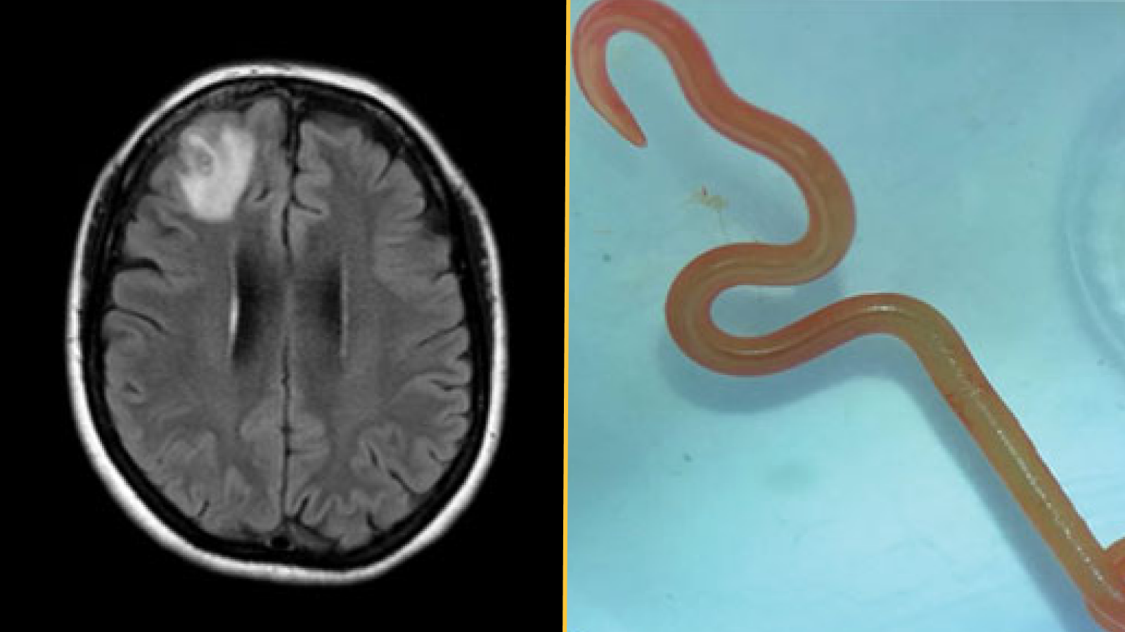 (left) Magnetic resonance image of patient’s brain by fluid-attenuated inversion recovery demonstrating an enhancing right frontal lobe lesion, 13 0d7 10 mm. (right) Live third-stage larval form of O. robertsi (80 mm long, 1 mm diameter) under stereomicroscope (original magnification 0d710).
