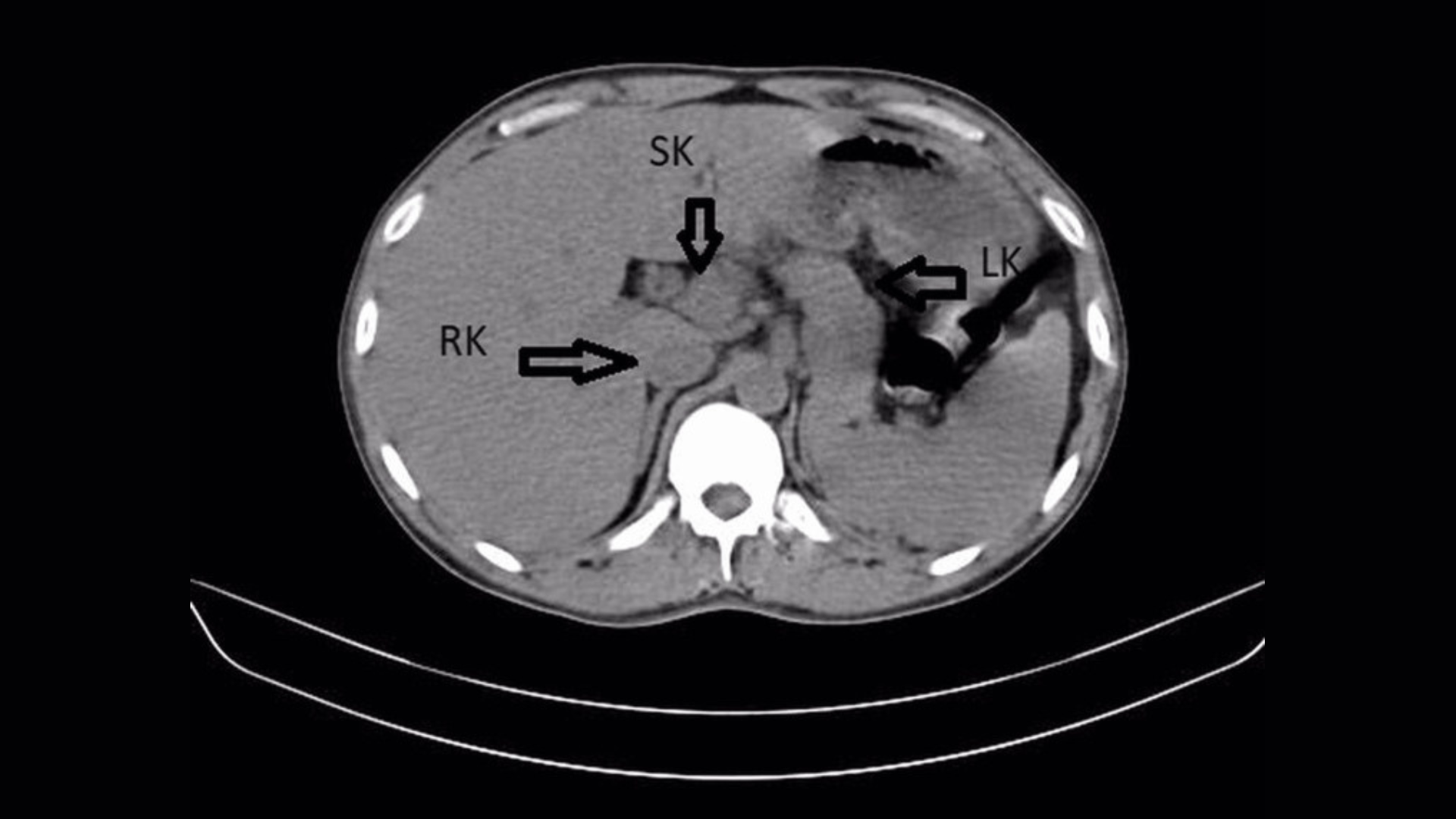 Image radiographique montrant une coupe transversale du dos humain, avec un cercle blanc des vertèbres vers le bas entouré de tissu gris. Trois flèches pointent vers la gauche, la droite et le bas à côté de trois cercles dans la zone grise. 