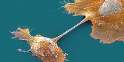 Un médicament expérimental double la survie à un an dans le cancer du pancréas