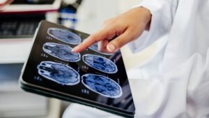 Le « gel cérébral » induit par un médicament pourrait aider à protéger le cerveau après un accident vasculaire cérébral, selon une première étude