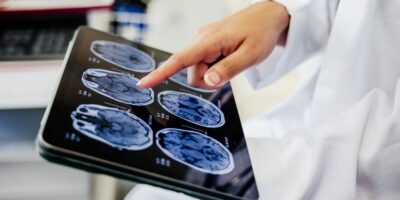 Le « gel cérébral » induit par un médicament pourrait aider à protéger le cerveau après un accident vasculaire cérébral, selon une première étude