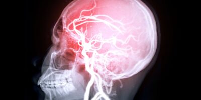 Les problèmes cardiaques liés aux « microdommages » dans le cerveau pourraient augmenter le risque de perte de mémoire, selon une étude