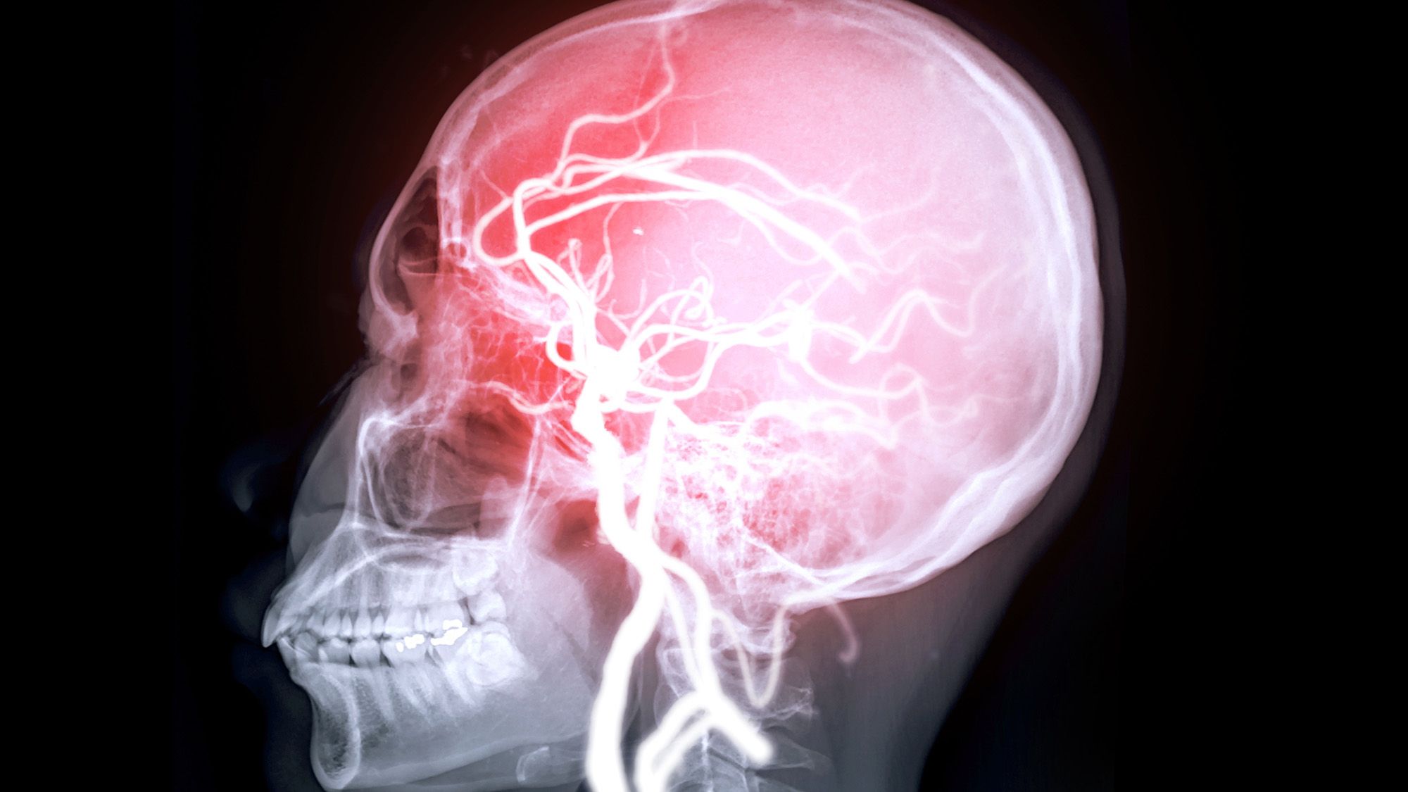 Les problèmes cardiaques liés aux « microdommages » dans le cerveau pourraient augmenter le risque de perte de mémoire, selon une étude