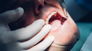 Les bactéries à l’origine des maladies des gencives peuvent également endommager vos valvules cardiaques, suggèrent les premières recherches
