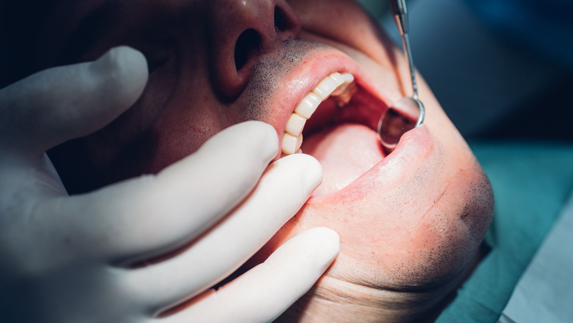 Les bactéries à l’origine des maladies des gencives peuvent également endommager vos valvules cardiaques, suggèrent les premières recherches