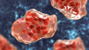 Illustration of measles virus infection showing giant multinucleated cells seen during microscopy of biopsy specimens, known as Warthin-Finkeldey giant cells.