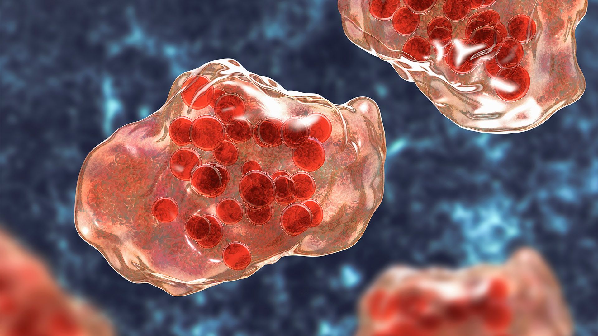 Illustration of measles virus infection showing giant multinucleated cells seen during microscopy of biopsy specimens, known as Warthin-Finkeldey giant cells.