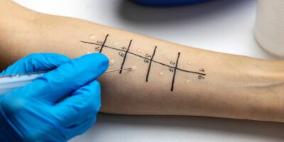 Dilemme diagnostique : une femme a reçu une greffe de poumon – et s’est également retrouvée avec une allergie aux arachides