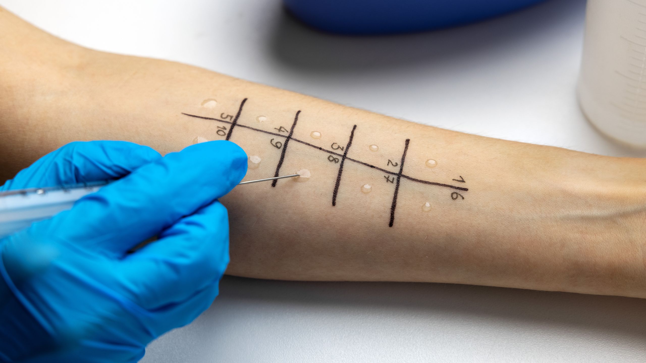 Dilemme diagnostique : une femme a reçu une greffe de poumon – et s’est également retrouvée avec une allergie aux arachides