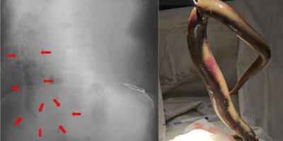 Dilemme diagnostique : le côlon du pêcheur percé par une anguille qui s&rsquo;est faufilée par son rectum