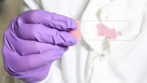 L'IA entraînée à « penser » comme les pathologistes humains pourrait être meilleure pour détecter le cancer