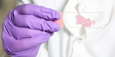 L&rsquo;IA entraînée à « penser » comme les pathologistes humains pourrait être meilleure pour détecter le cancer