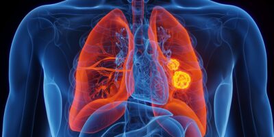 Des scientifiques identifient une mutation génétique rare qui augmente considérablement le risque de cancer du poumon chez les non-fumeurs