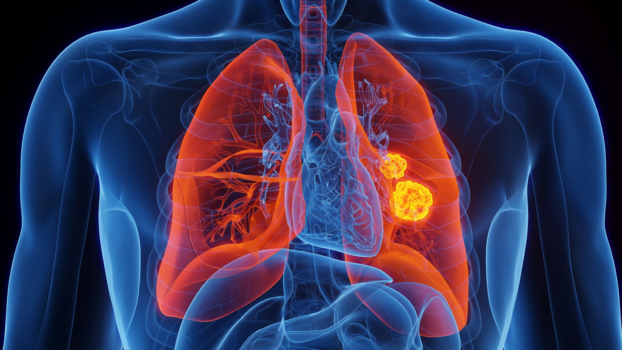 Des scientifiques identifient une mutation génétique rare qui augmente considérablement le risque de cancer du poumon chez les non-fumeurs