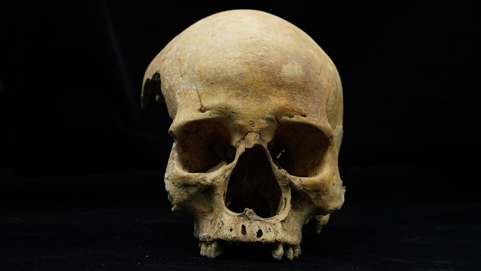 a front-facing human skull minus the mandible against a black background, revealing a curiously wide nasal opening