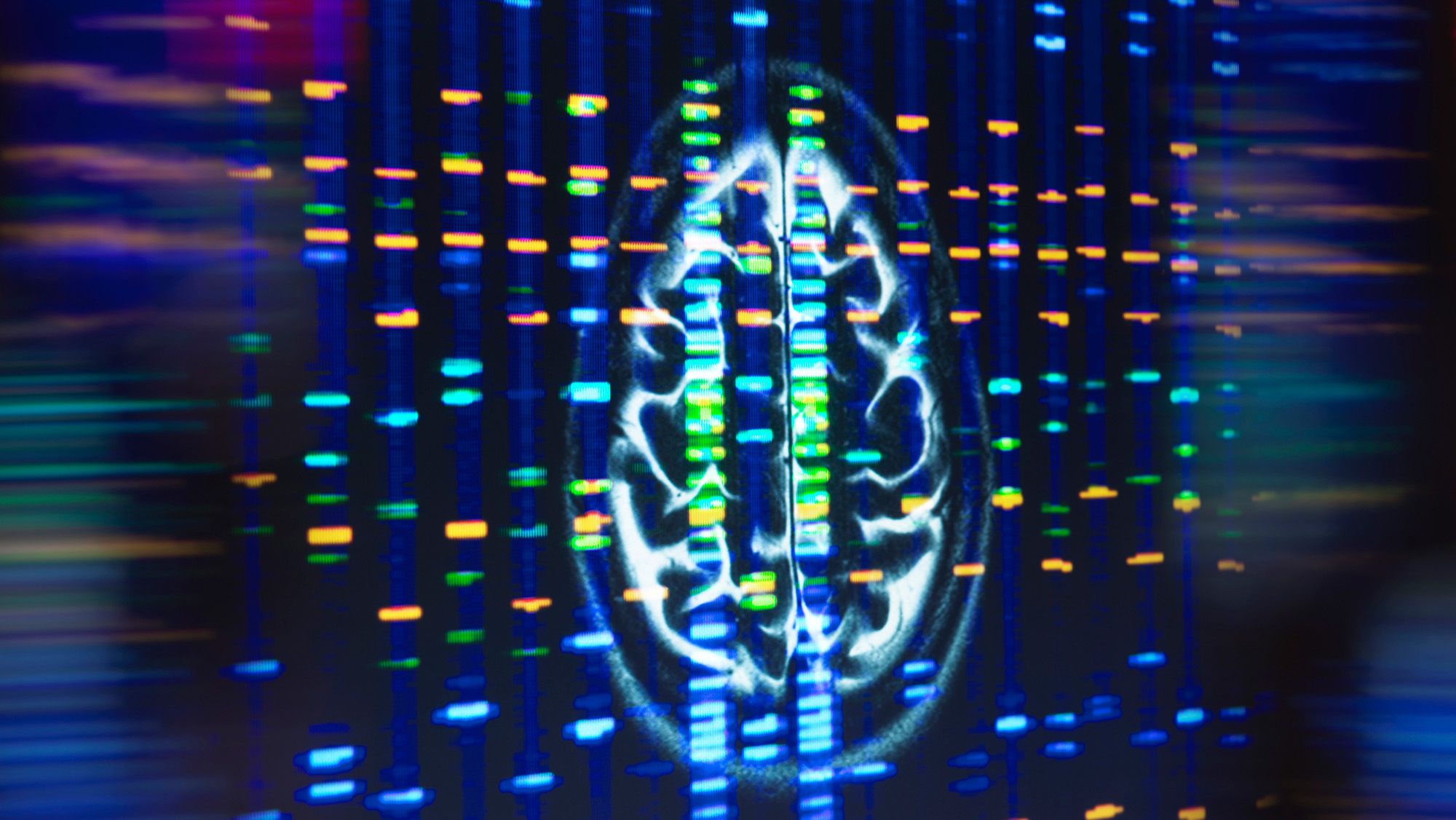 Une variante génétique triple le risque de contracter la maladie d'Alzheimer – l'accumulation de graisse dans les cellules cérébrales pourrait en être la cause, selon une étude
