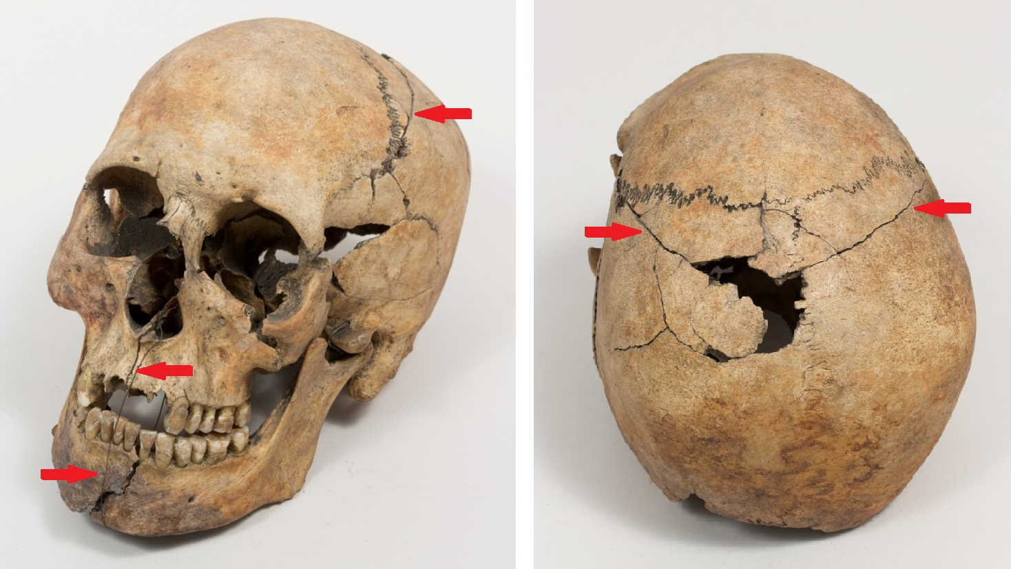 deux vues d'un crâne humain montrant les dommages post-mortem et la reconstruction