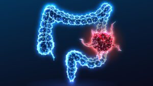 Une étude révèle de nouveaux indices expliquant pourquoi le cancer colorectal est si mortel chez les jeunes