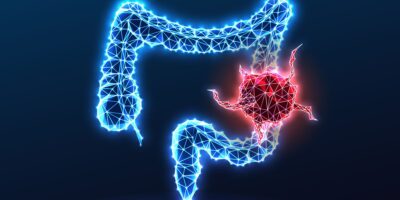 Une étude révèle de nouveaux indices expliquant pourquoi le cancer colorectal est si mortel chez les jeunes